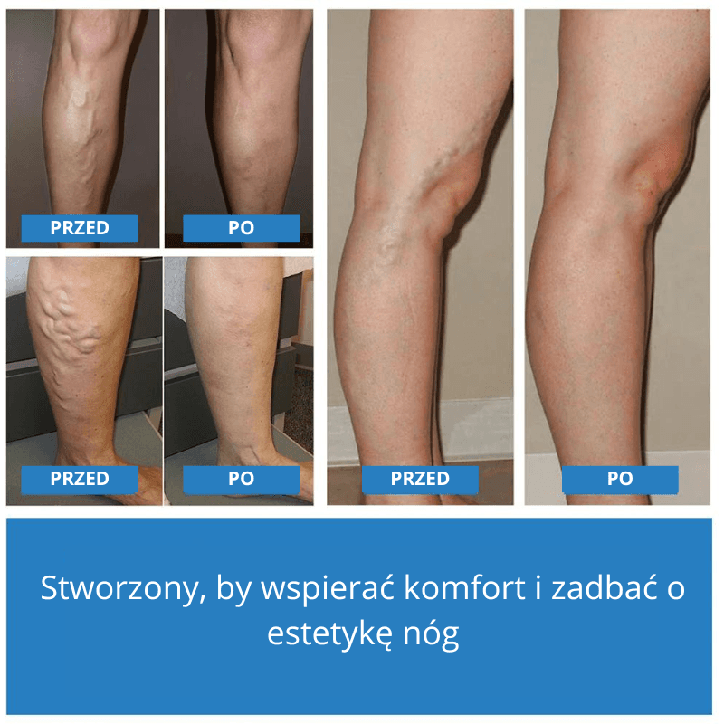 BluePoint™ Laserowe pióro wspierające regenerację skóry nóg