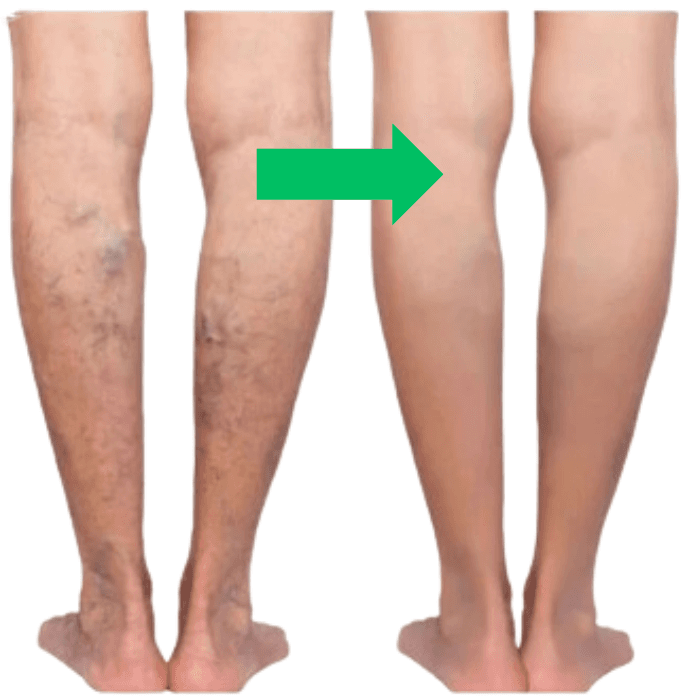 BluePoint™ Laserowe pióro wspierające regenerację skóry nóg