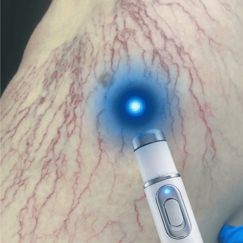 BluePoint™ Laserowe pióro wspierające regenerację skóry nóg